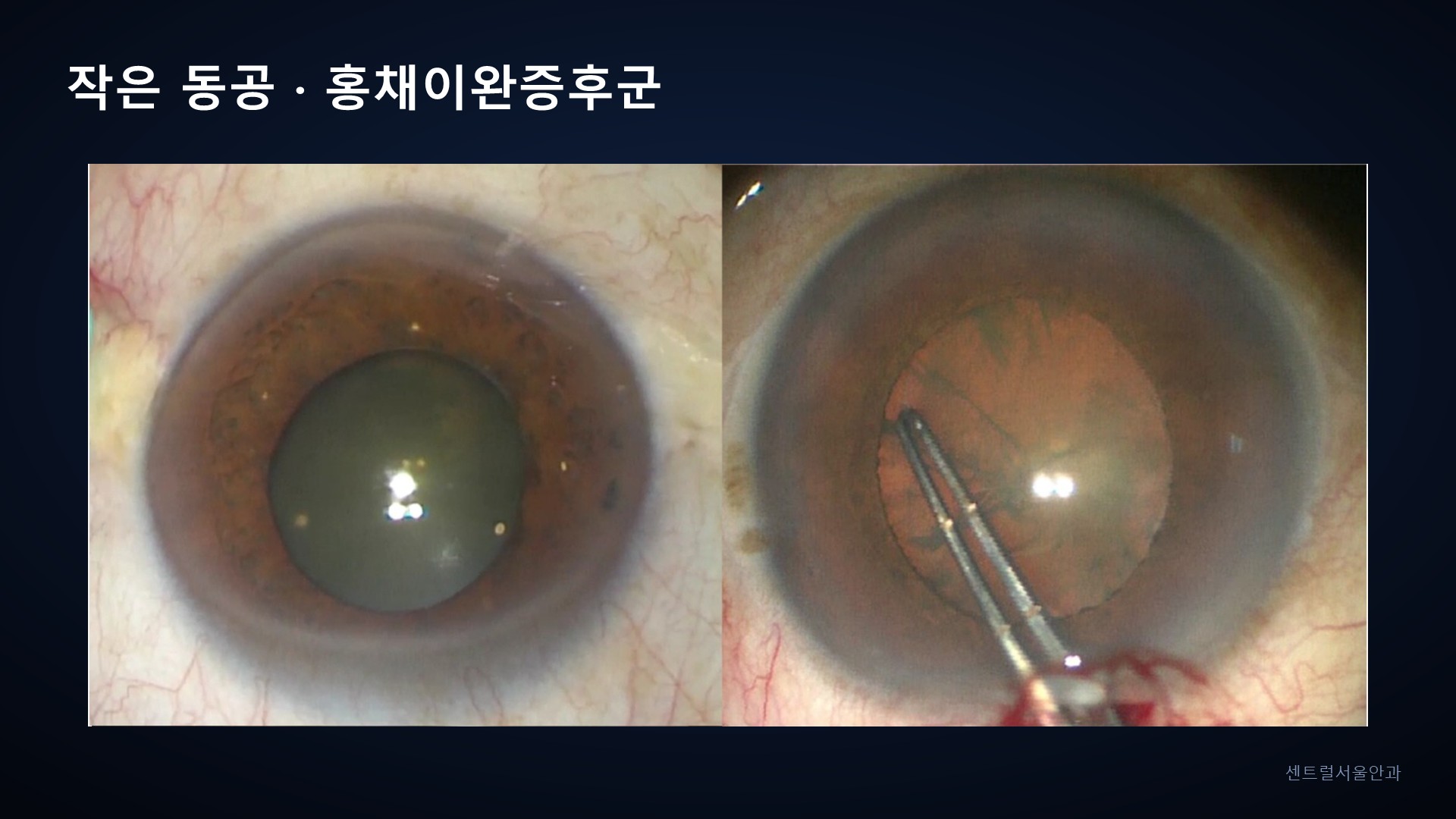 작은 동공 · 홍채이완증후군