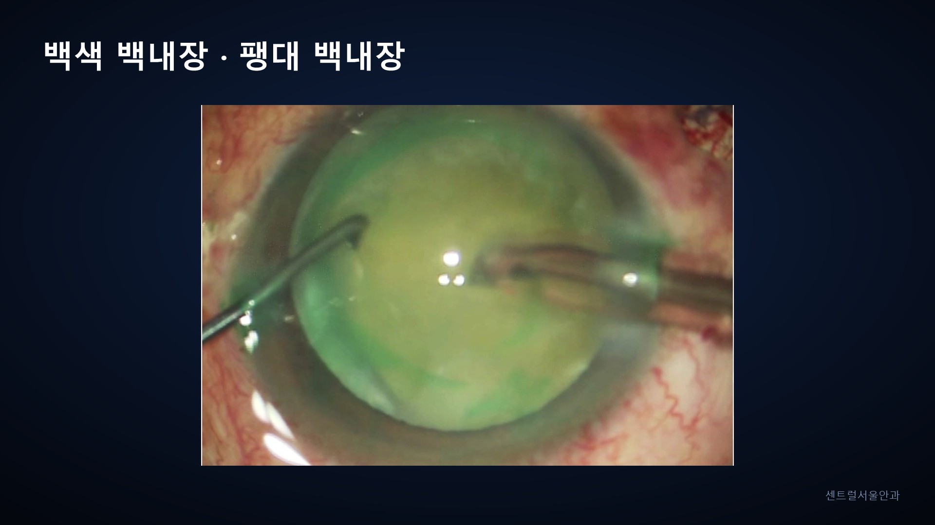 백색 · 팽대 백내장